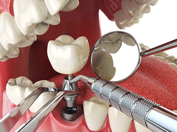 Best Emergency Root Canal Treatment in Echelon, NJ
